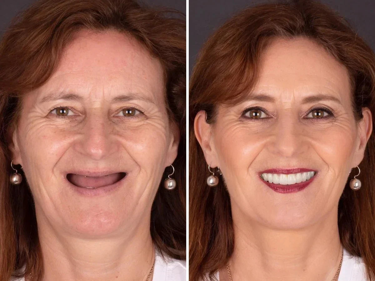 NESLEMY® BioFusion Dentures🦷Suitable for all mouth shapes, perfect fit🦷