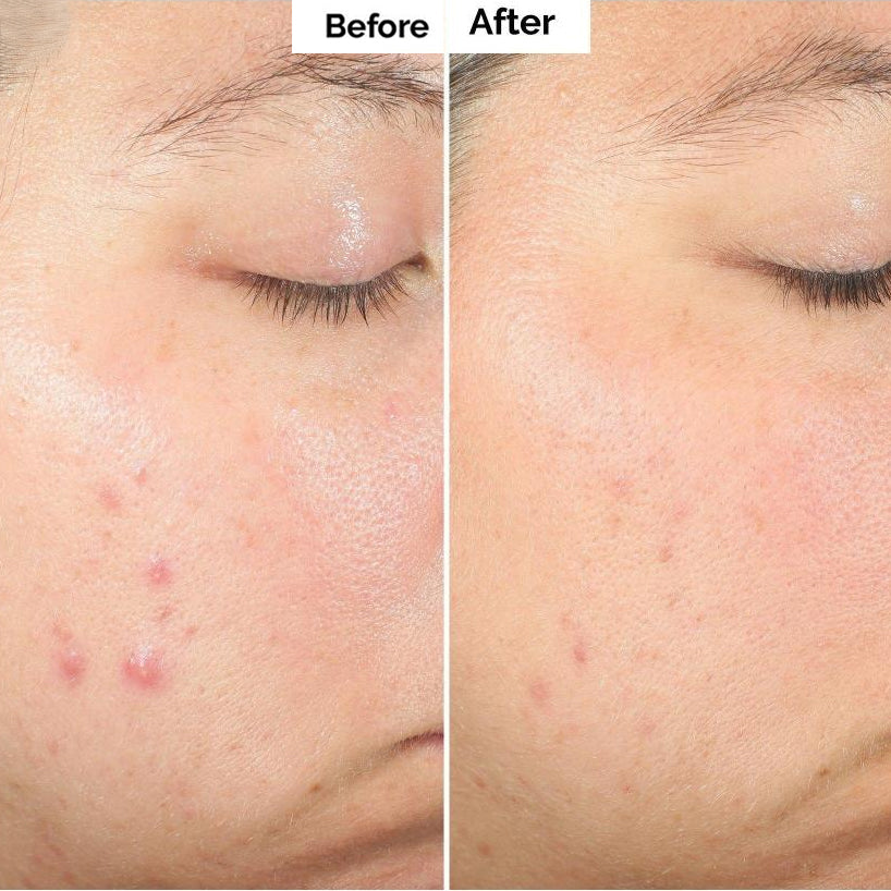 🌿Alisanda™ Pore & Spot Care Duo| Shrinks Pores & Fades Blemish Marks