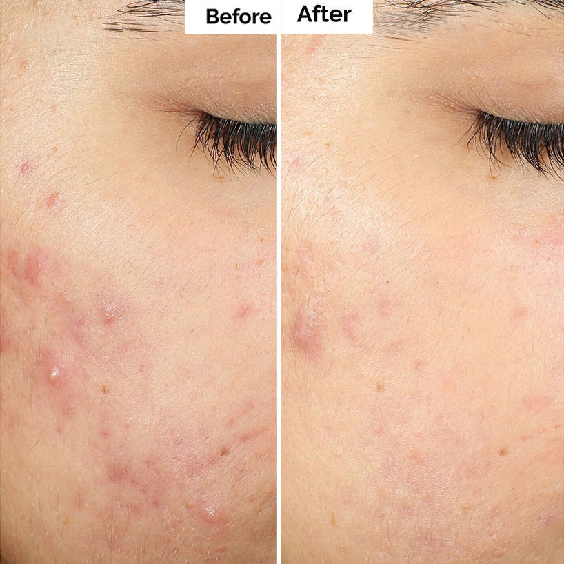 🌿Alisanda™ Pore & Spot Care Duo| Shrinks Pores & Fades Blemish Marks