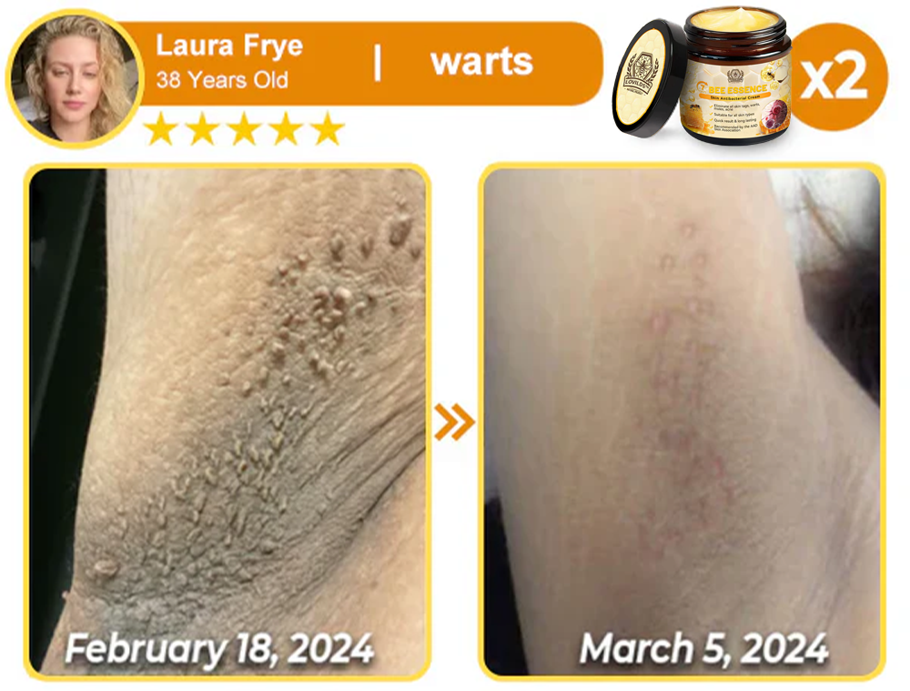 š„LOVILDS⢠Bee Essence Skin Antibacterial Creamāused to treat a variety of skin diseases (AAD recommended).