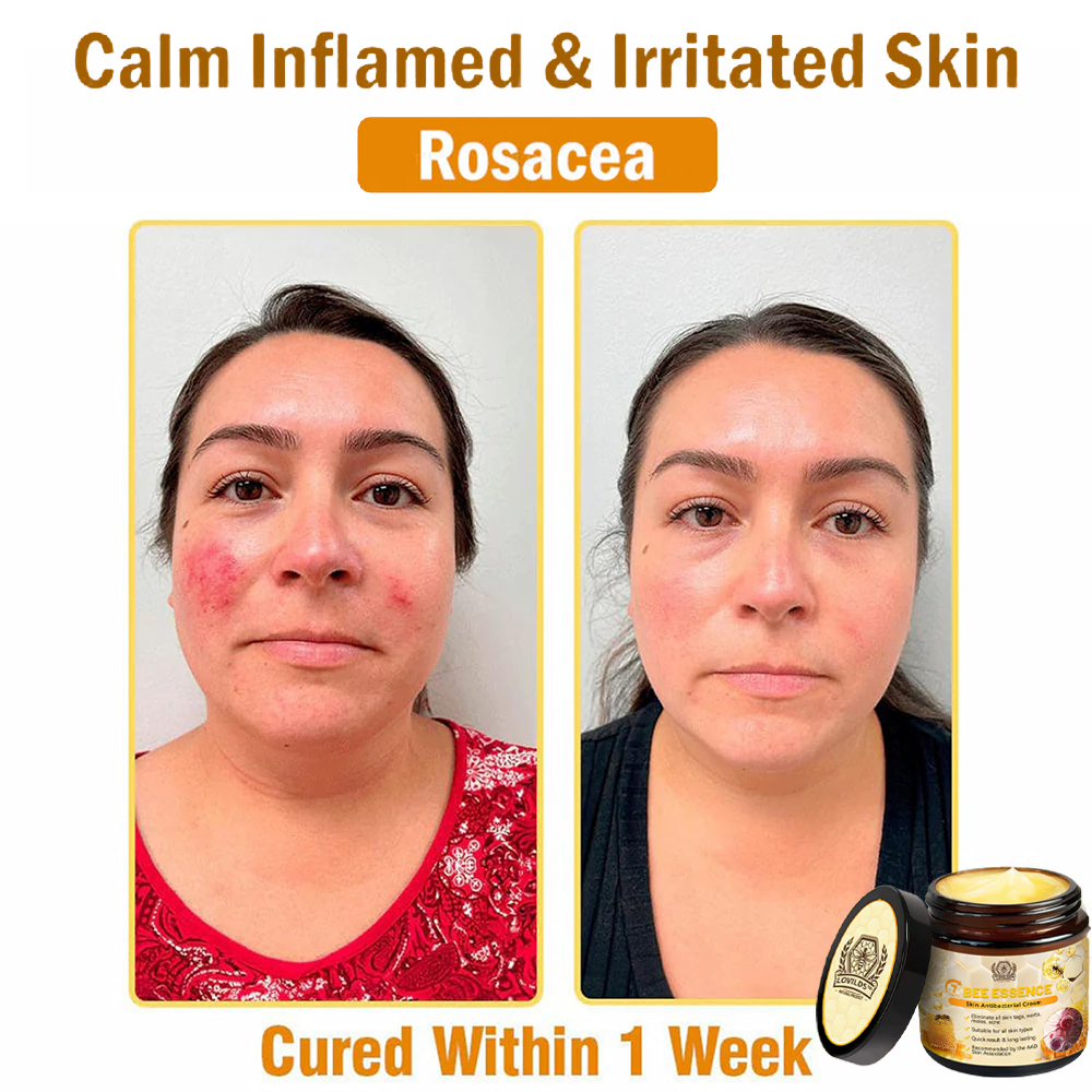 š„LOVILDS⢠Bee Essence Skin Antibacterial Creamāused to treat a variety of skin diseases (AAD recommended).