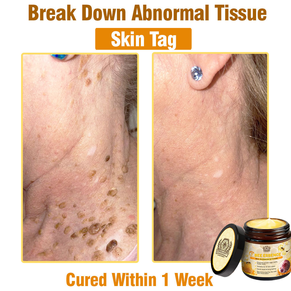 š„LOVILDS⢠Bee Essence Skin Antibacterial Creamāused to treat a variety of skin diseases (AAD recommended).