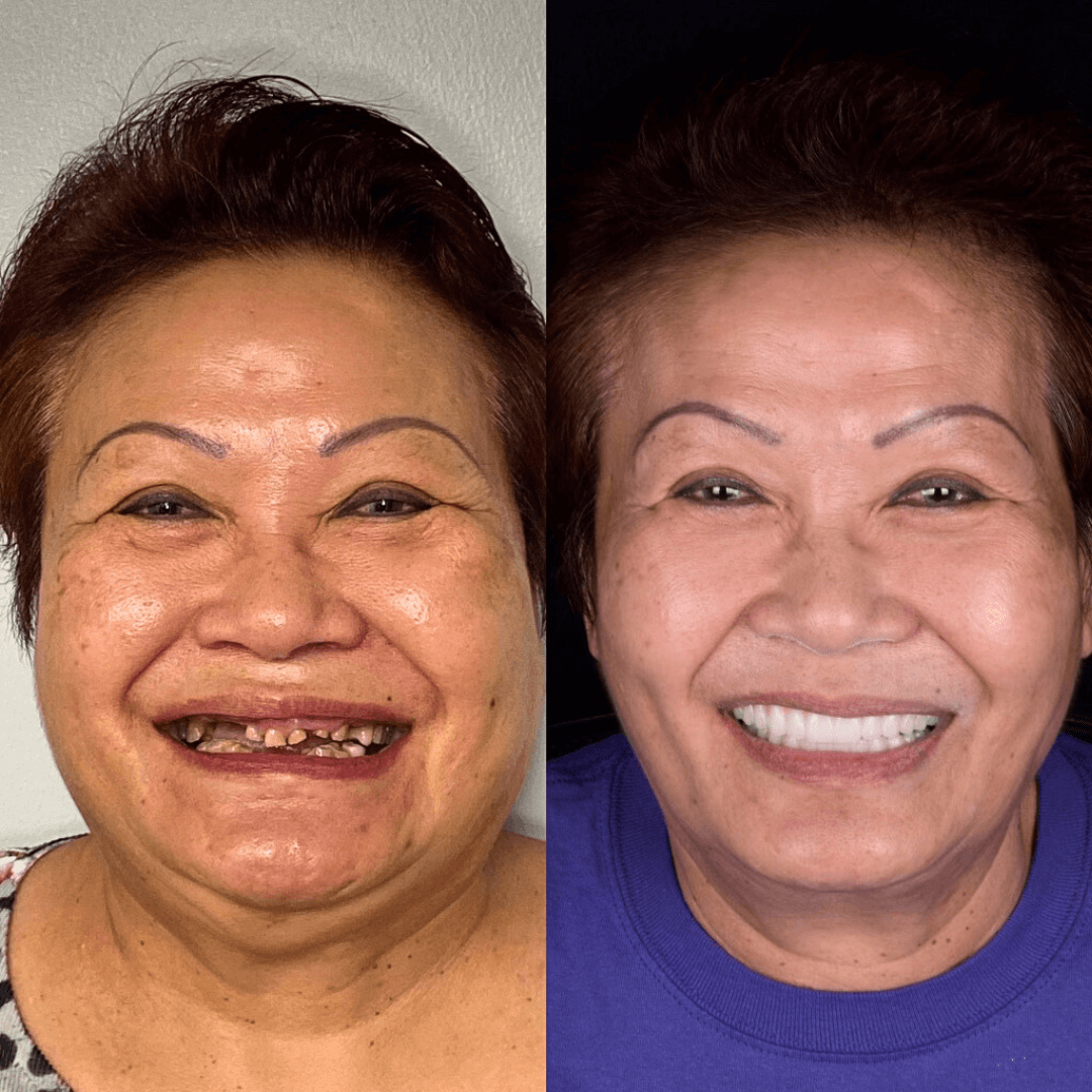 NESLEMY® BioFusion Dentures🦷Suitable for all mouth shapes, perfect fit🦷