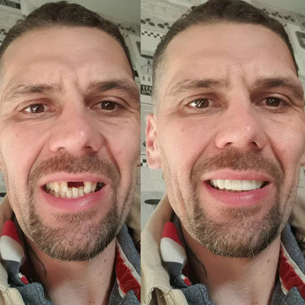 NESLEMY® BioFusion Dentures🦷Suitable for all mouth shapes, perfect fit🦷