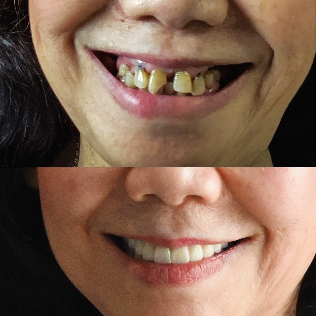 NESLEMY® BioFusion Dentures🦷Suitable for all mouth shapes, perfect fit🦷