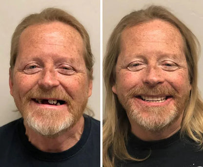 NESLEMY® BioFusion Dentures🦷Suitable for all mouth shapes, perfect fit🦷